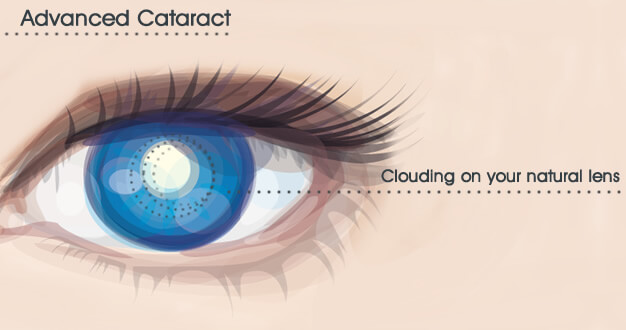 Advanced Cataract Eye Surgery