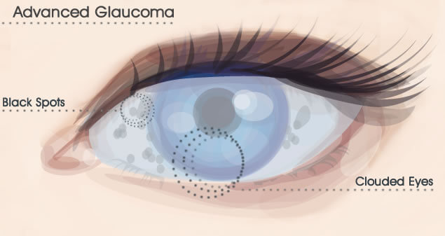Glaucoma Eye Treatment